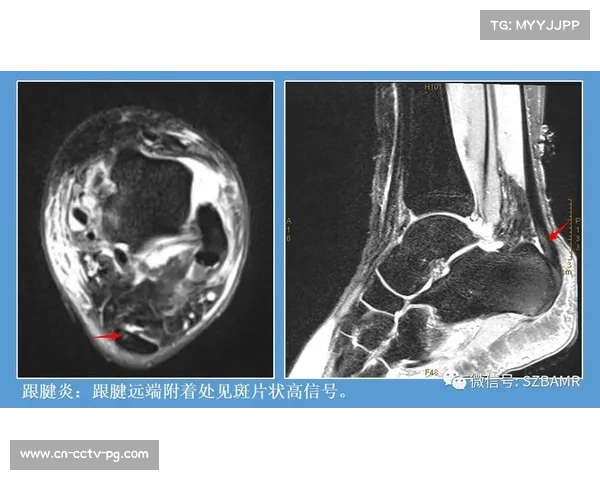 短跑运动损伤防护指南更新 强化跟腱保护警示与预防措施 短跑运动损伤防护指南更新 强化跟腱保护警示与预防措施